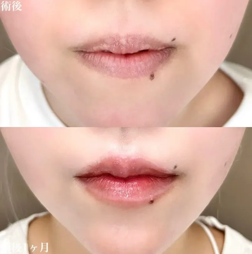 札幌でヒアルロン酸注射ができるおすすめのクリニック TCBの症例写真