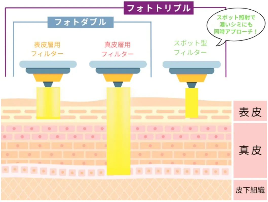 湘南美容クリニックのIPL光治療の施術イメージ