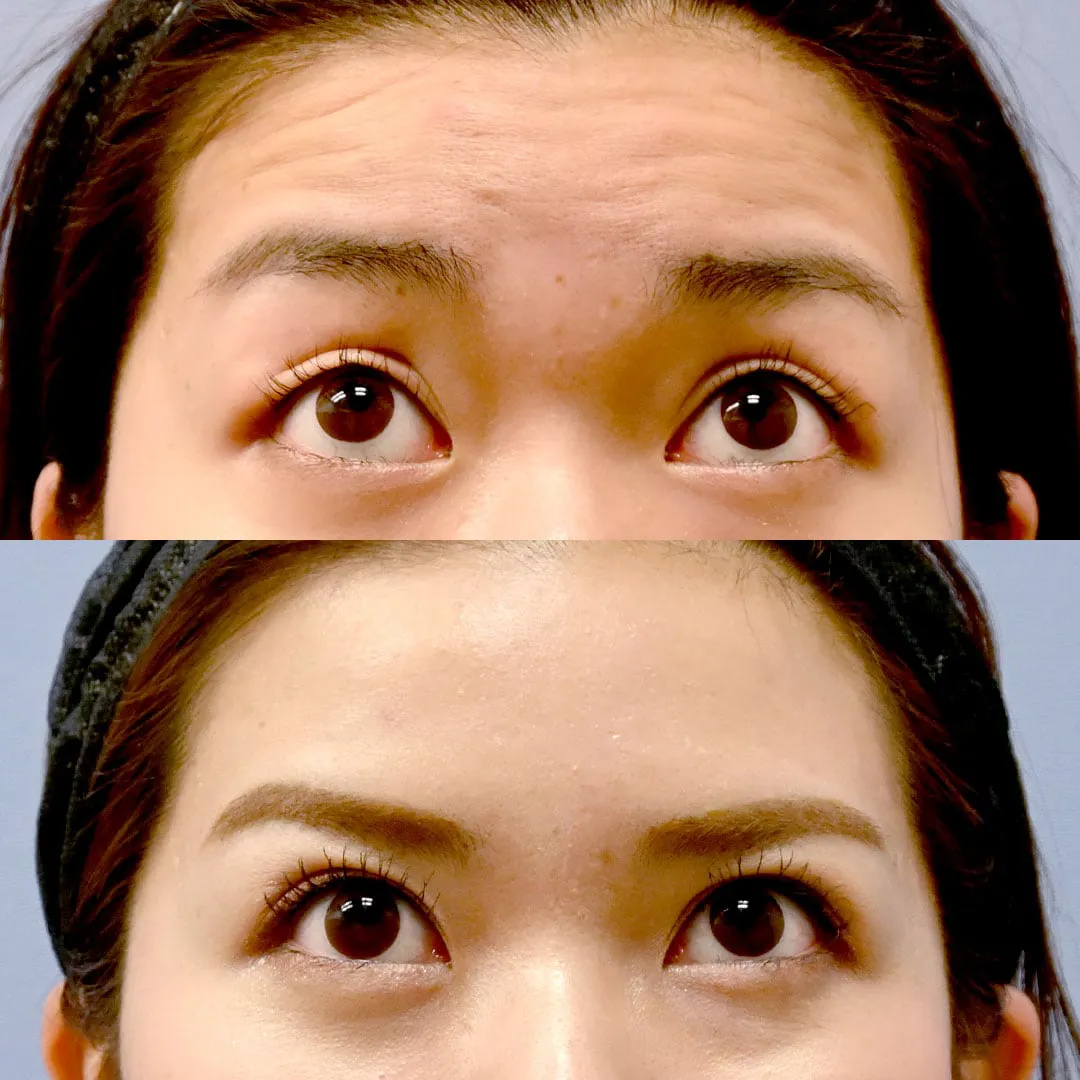 大阪でボトックスが上手い湘南美容皮フ科梅田茶屋町院 池内理絵医師の症例写真