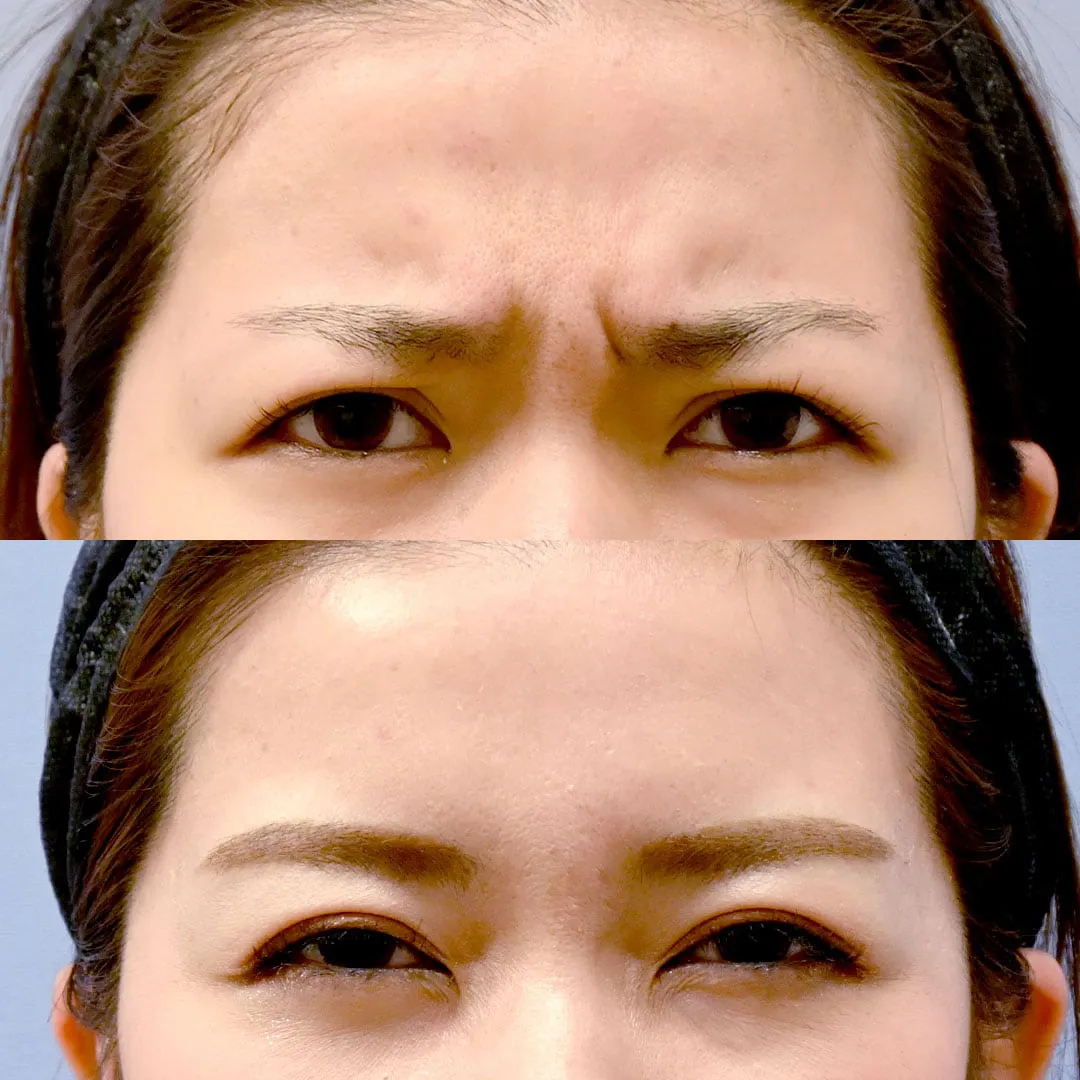 大阪でボトックスが上手い湘南美容皮フ科梅田茶屋町院 池内理絵医師の症例写真