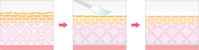 大阪でケミカルピーリングが安いおすすめのクリニック 湘南美容クリニックの施術方法