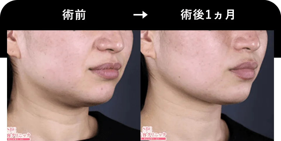 湘南美容クリニックの医療ハイフ症例写真