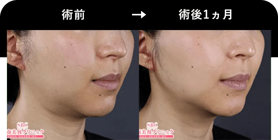 湘南美容クリニックの医療ハイフ症例写真