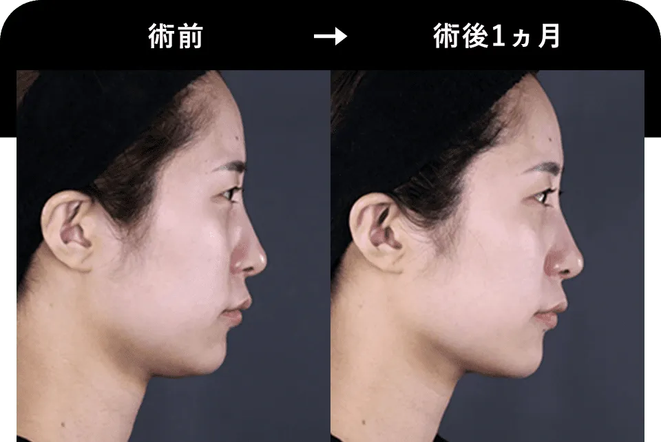 湘南美容クリニックの医療ハイフ症例写真