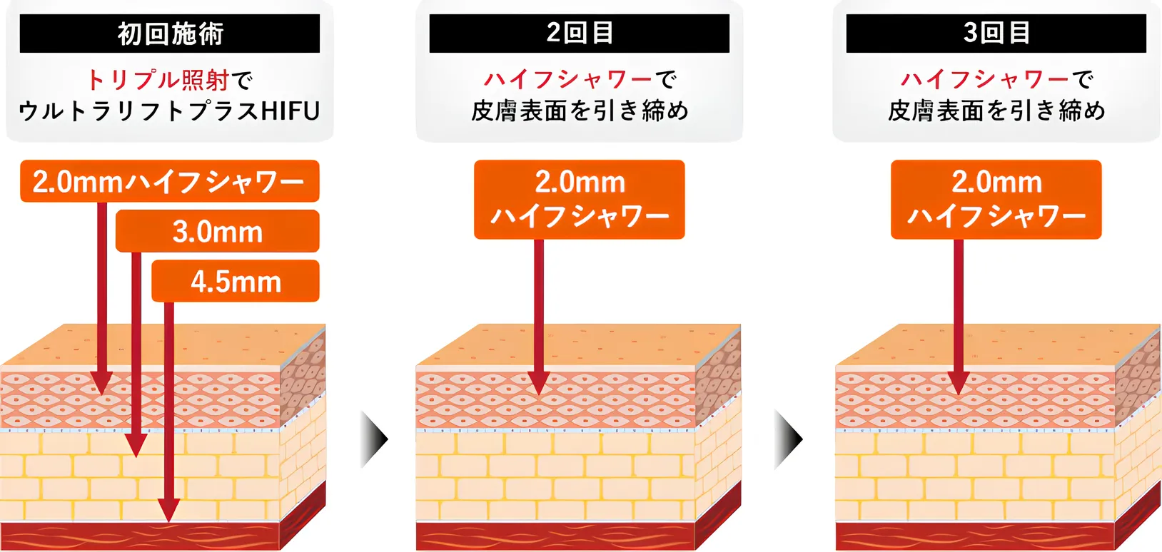 湘南美容クリニックの医療ハイフ3回セット