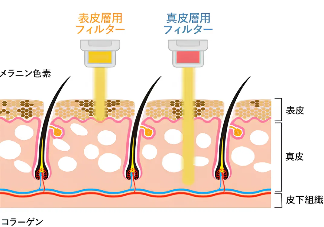 韓流肌になれる湘南美容クリニックのIPL(フォトダブル)