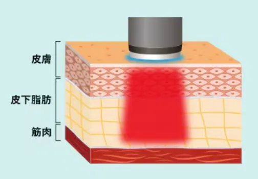 神戸でオンダリフトが安いおすすめクリニック 湘南美容クリニックONDA PROのハンドピース