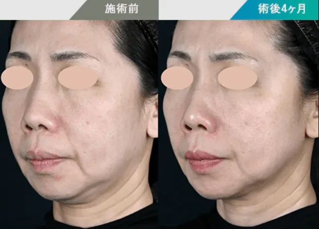 神戸でオンダリフトが安いクリニック 湘南美容クリニックの症例写真