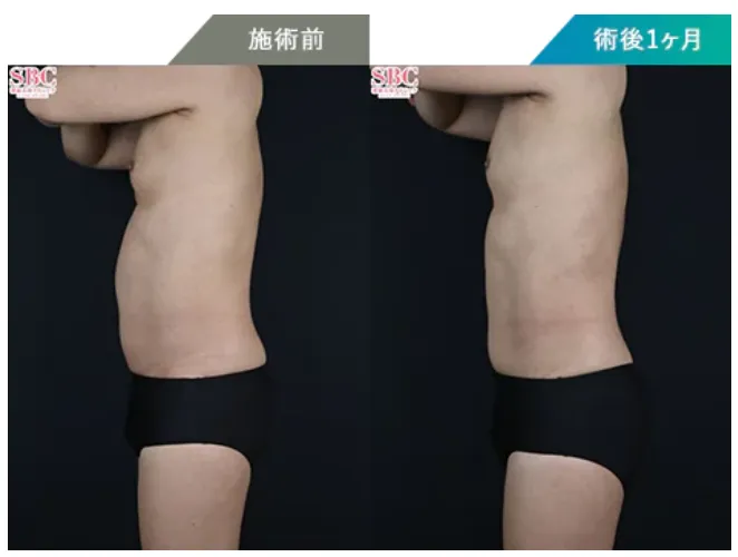 神戸でオンダリフトが安いおすすめクリニック 湘南美容クリニックの症例写真