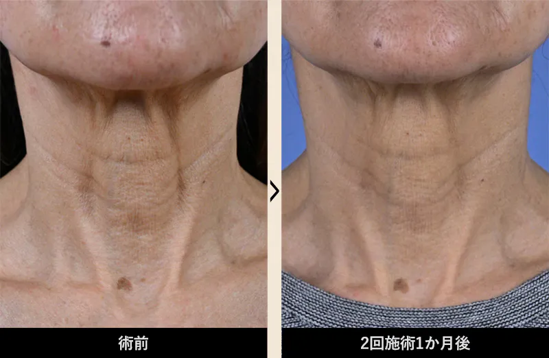 湘南美容クリニックのプロファイロ症例写真