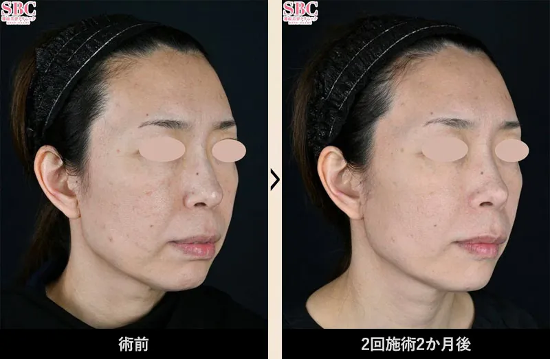 湘南美容クリニックのプロファイロ症例写真