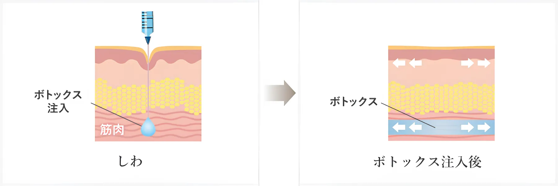 湘南美容クリニックのメンズシワ取り(ほうれい線)