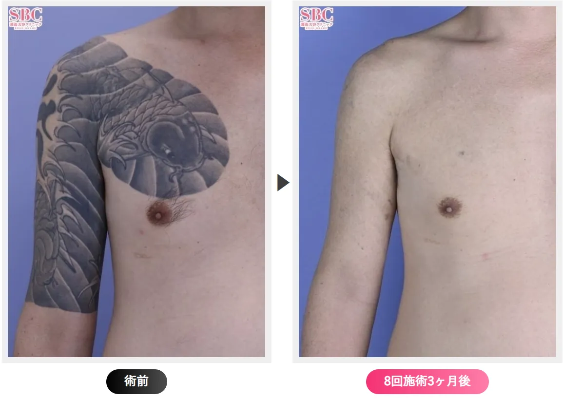 モニター利用でお得にタトゥー除去が受けられる湘南美容クリニックの症例写真