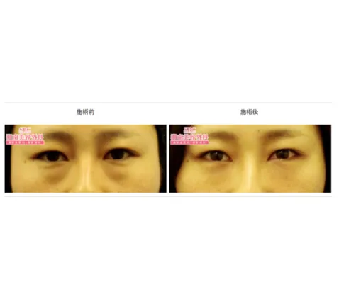 SBCの裏ハムラ法の症例