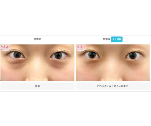 SBCの裏ハムラ法の症例