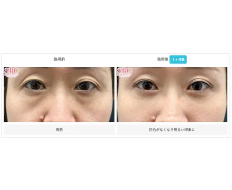 SBCの裏ハムラ法の症例