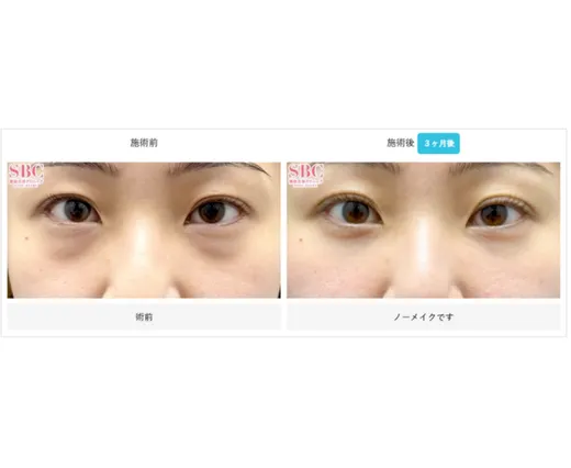 SBCの裏ハムラ法の症例