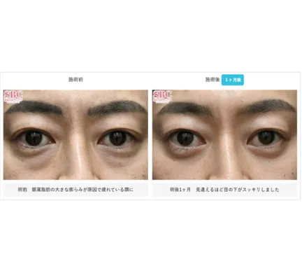 SBCの裏ハムラ法の症例