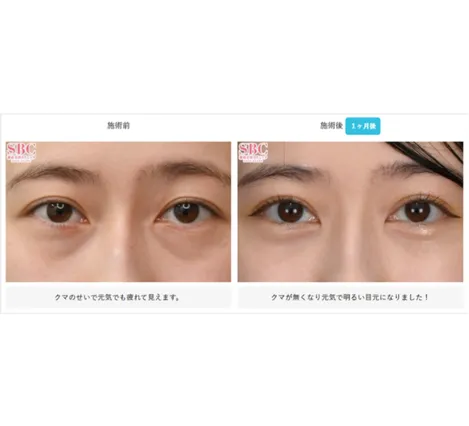 SBCの裏ハムラ法の症例