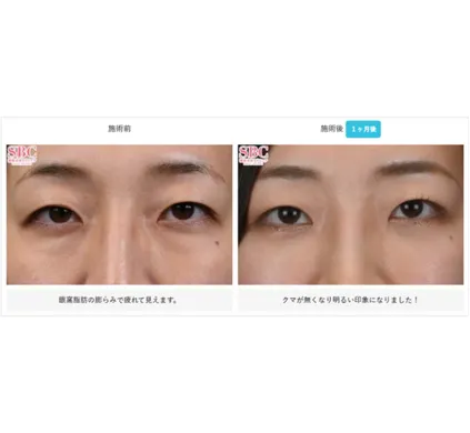 SBCの裏ハムラ法の症例