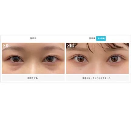 SBCの裏ハムラ法の症例