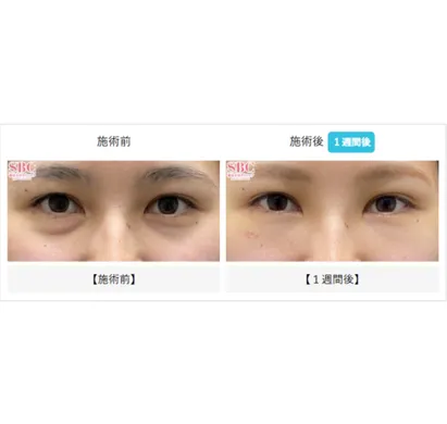 SBCの裏ハムラ法の症例