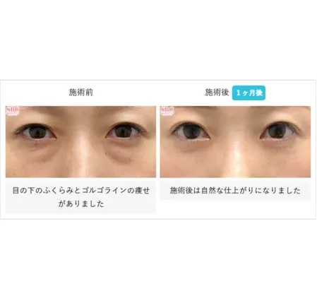 SBCの裏ハムラ法の症例