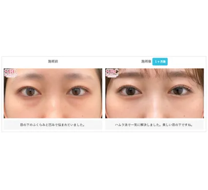 SBCの裏ハムラ法の症例