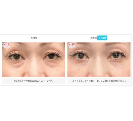 SBCの裏ハムラ法の症例