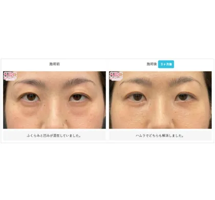 SBCの裏ハムラ法の症例