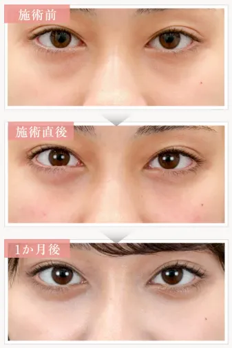 口コミで話題のTクリニックのクマ取り症例①