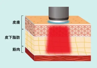 湘南美容クリニックのオンダリフトについて