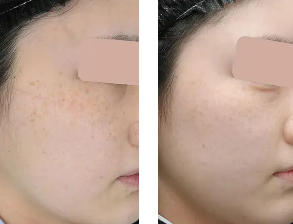 湘南美容クリニックのフォトフェイシャルの症例