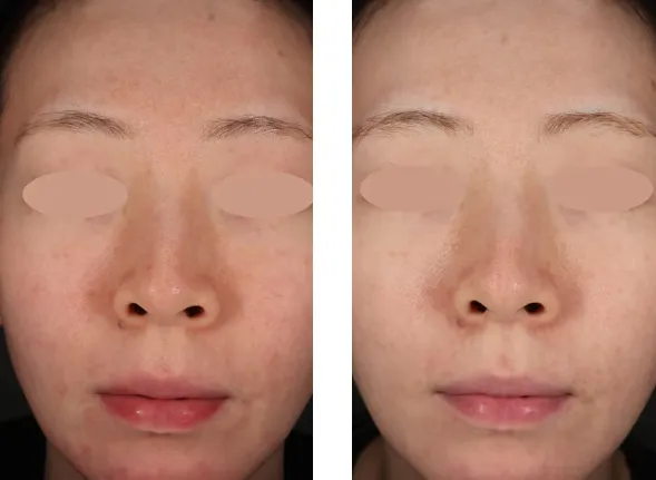 湘南美容クリニックのフォトフェイシャルの症例