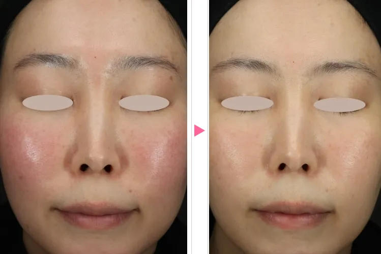 湘南美容クリニックのフォトフェイシャルの症例