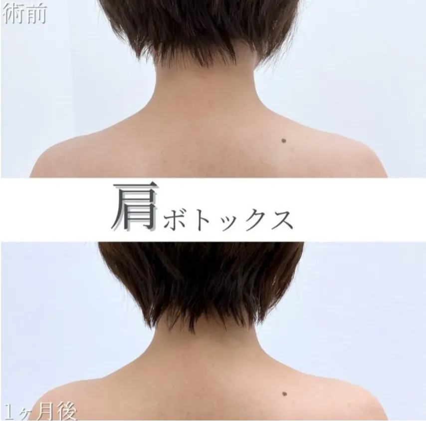 仙台でおすすめの肩ボトックスが受けられるTCBの症例写真