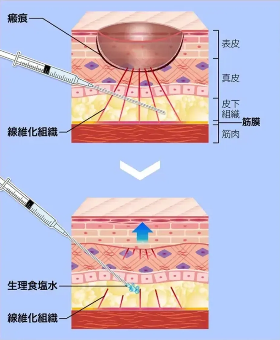 仙台 安い おすすめ TCBサブシジョンの治癒の過程