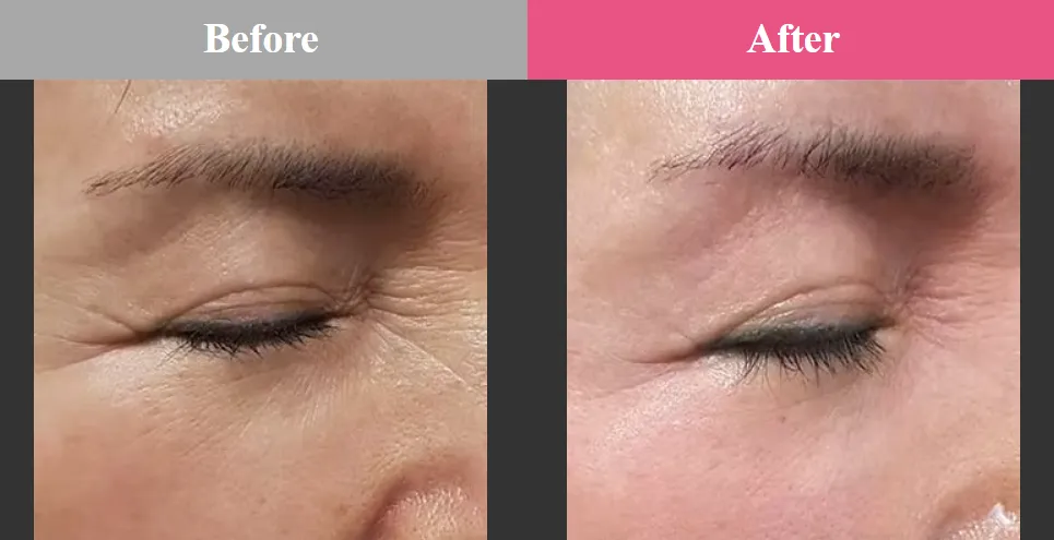 札幌でエリシスセンスが安いおすすめクリニック 品川スキンクリニックの症例写真