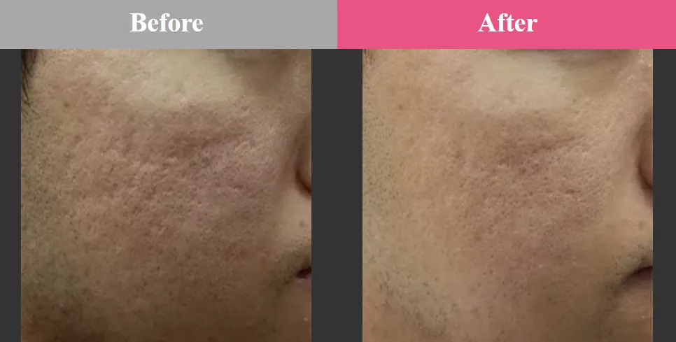 札幌でエリシスセンスが安いおすすめクリニック 品川スキンクリニックの症例写真