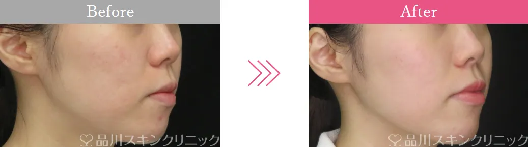 札幌でエリシスセンスが安いおすすめクリニック 品川グループの症例写真