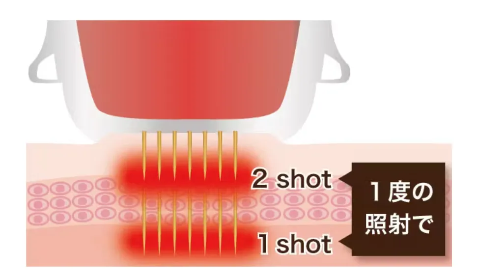 札幌でエリシスセンスが安いおすすめクリニック 品川スキンクリニックのエリシスセンスのダブルショット機能