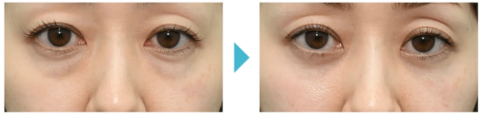 新潟でモフィウス8が安い湘南美容クリニックの症例写真