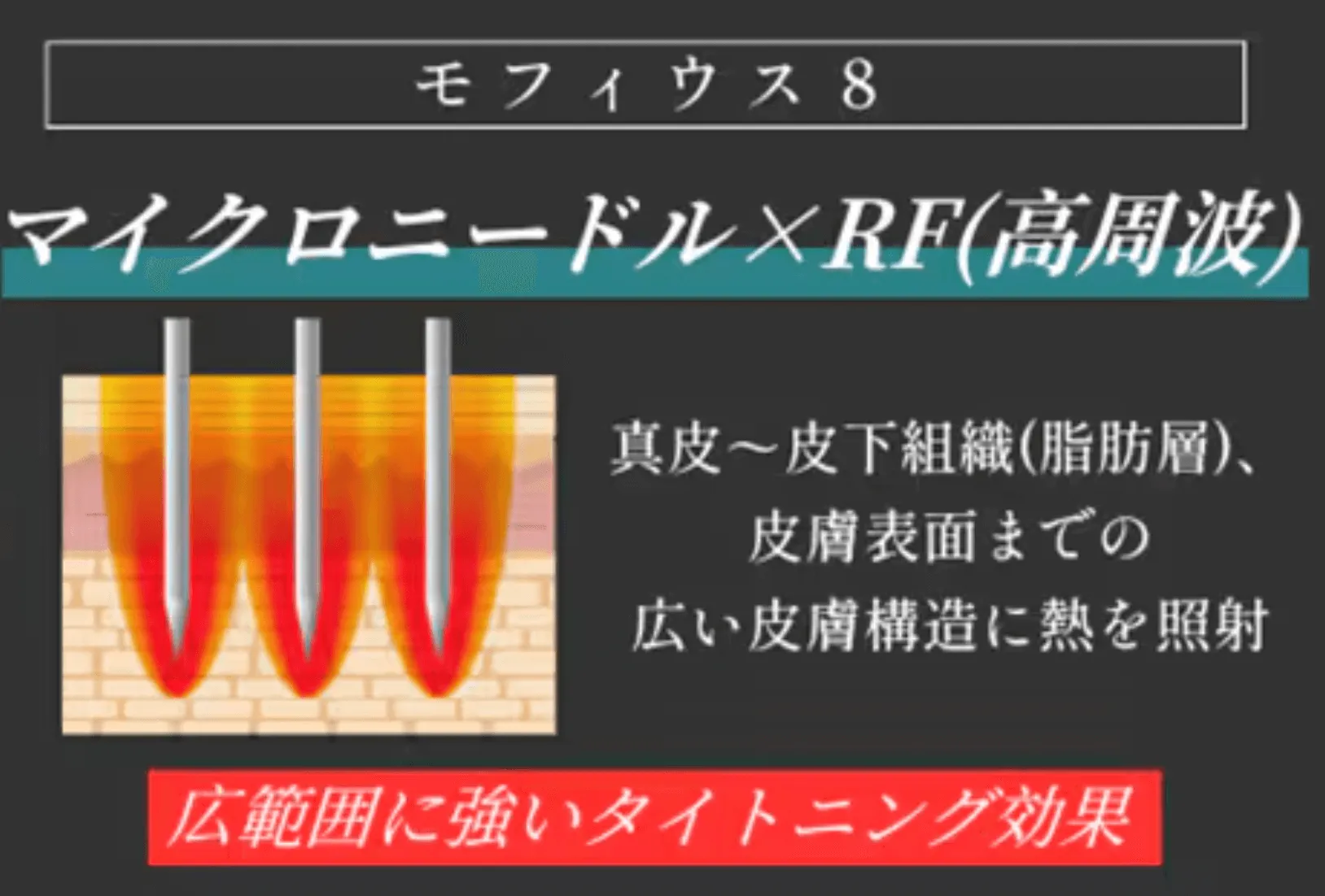新潟でモフィウス8が安い湘南美容クリニックの施術の説明
