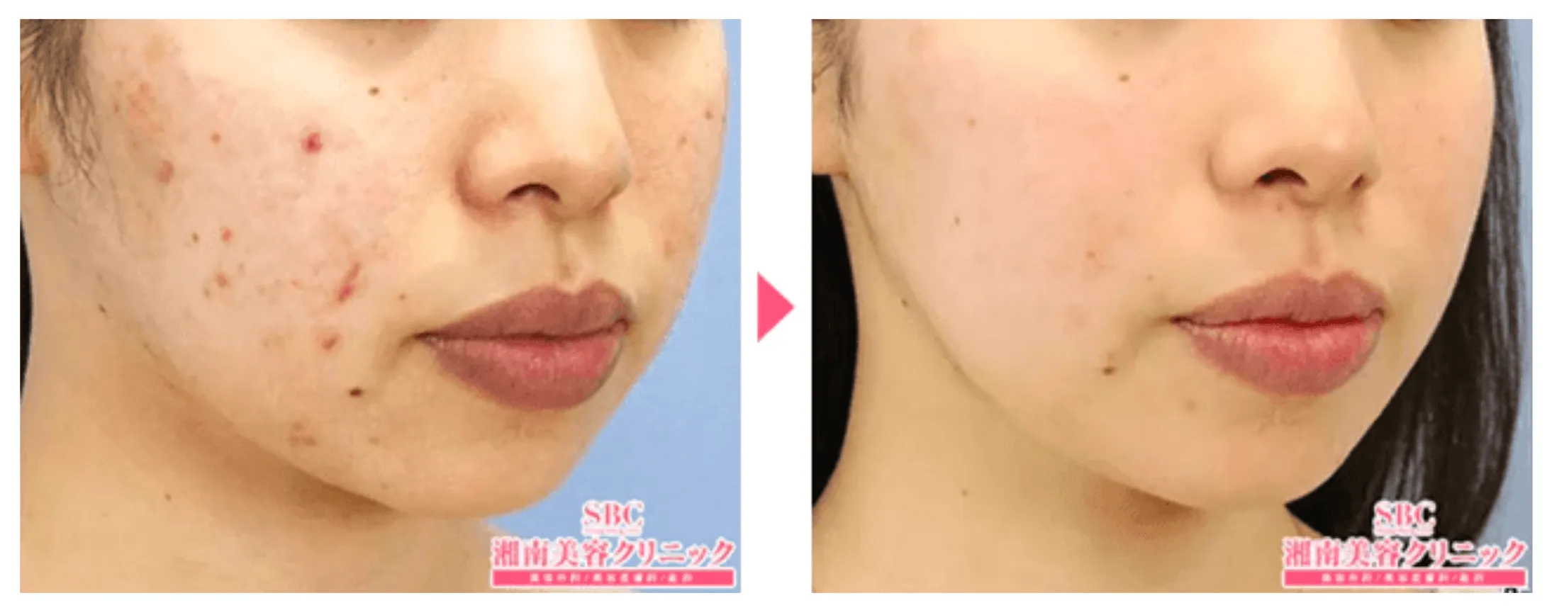 仙台にあるケミカルピーリングが安い湘南美容クリニックの症例画像