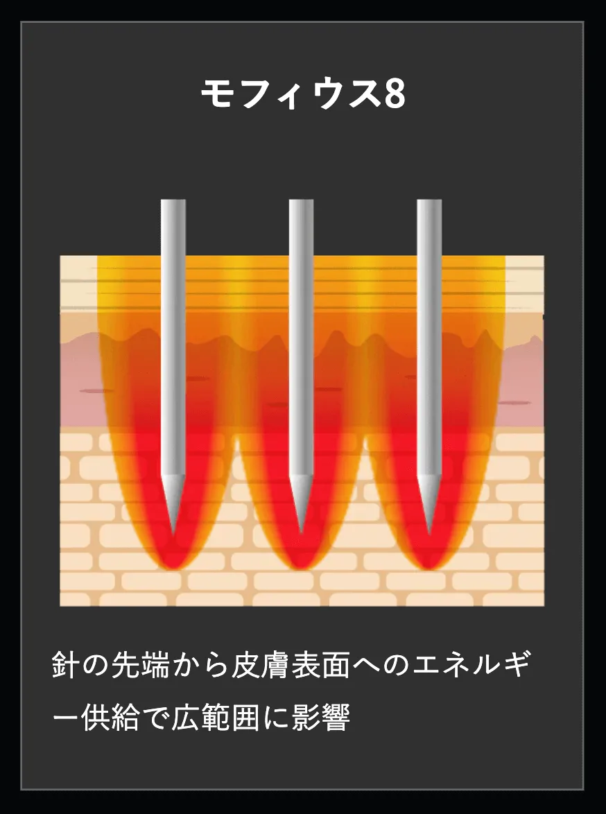 沖縄にある湘南美容クリニックのモフィウス8の説明
