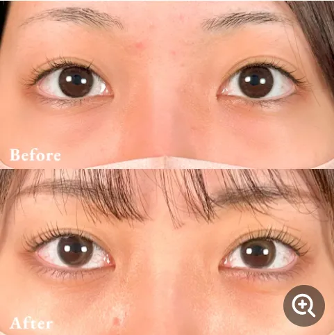 口コミで人気のTクリニックのクマ取り施術症例④