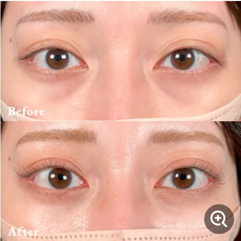 口コミで人気のTクリニックのクマ取り施術症例⑤