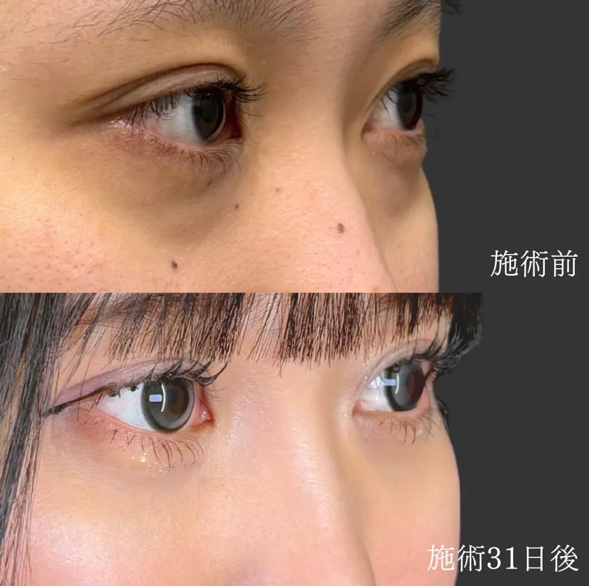 口コミで人気のTクリニックのクマ取り施術症例①