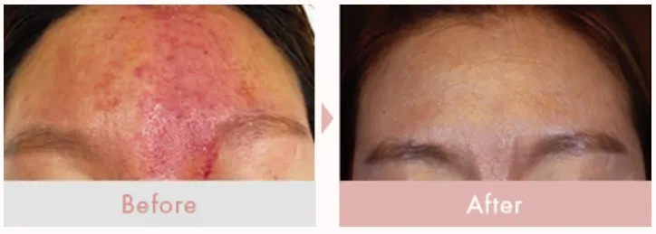 石川・金沢でイオン導入が安いとおすすめの湘南美容クリニックのイオン導入症例写真③