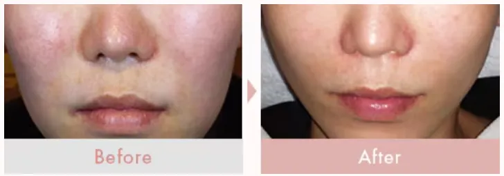 石川・金沢でイオン導入が安いとおすすめの湘南美容クリニックのイオン導入症例写真④